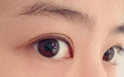 割雙眼皮后多久看起來才自然