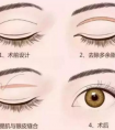 全切雙眼皮要多少天才能恢復自然