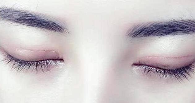 什么情況下割雙眼皮會比較好呢