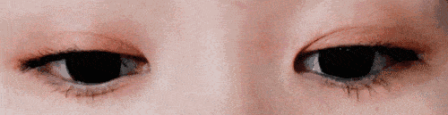 雙眼皮術(shù)后要注意什么呢