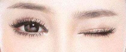 做埋線雙眼皮恢復(fù)快嗎