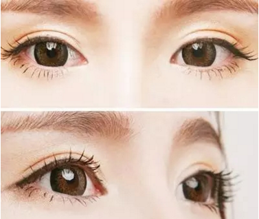 埋線雙眼皮需要注意的事項(xiàng)有哪些