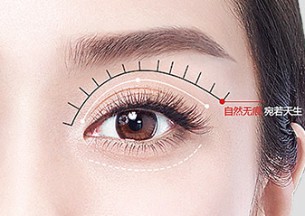 雙眼皮手術(shù)失敗會有什么癥狀