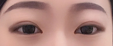 近視眼可以做雙眼皮手術(shù)嗎