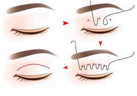 做雙眼皮手術(shù)過(guò)程痛不痛