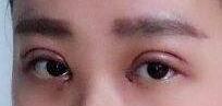 雙眼皮手術(shù)失敗了還能修復(fù)補(bǔ)救嗎