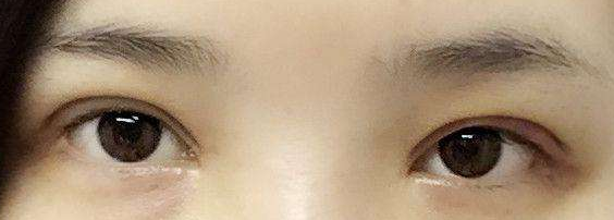 做切開雙眼皮手術(shù)會(huì)有疤痕嗎