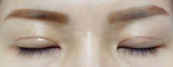 做切開雙眼皮手術(shù)會(huì)有疤痕嗎