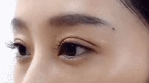做埋線雙眼皮手術(shù)的價格貴不貴