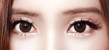 廣州做埋線雙眼皮手術(shù)多少錢