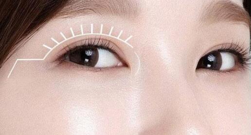 做埋線雙眼皮脫線了怎么辦