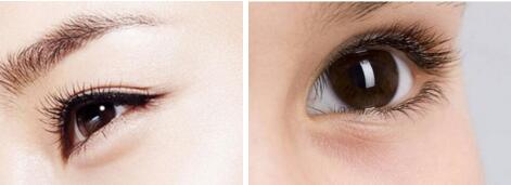 埋線雙眼皮會出現(xiàn)斷線的情況嗎