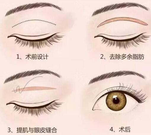 切開法雙眼皮多少錢