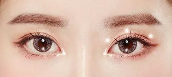 做雙眼皮手術會失敗嗎