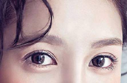 做切開雙眼皮手術要注意什么