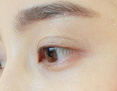 做埋線雙眼皮需要多少錢