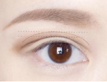 雙眼皮術(shù)后多久才會(huì)變得自然好看