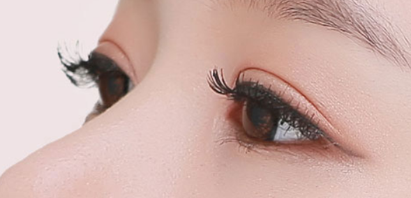 雙眼皮術(shù)后需要做好的護(hù)理事項