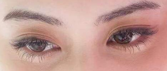 做切開雙眼皮術(shù)后會(huì)不會(huì)留疤