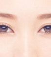 埋線雙眼皮的術后護理怎么做
