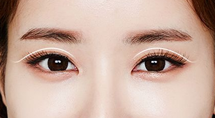 雙眼皮整形會有什么風(fēng)險(xiǎn)嗎