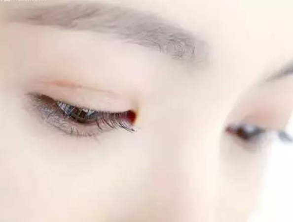 切開雙眼皮多少天可以拆線