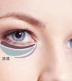 眼袋手術(shù)后的恢復(fù)期要多長