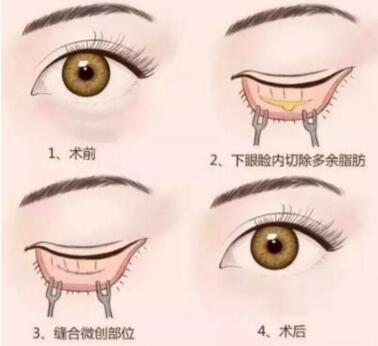 去眼袋手術(shù)要多少錢