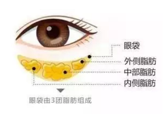 怎樣消除眼袋比較快