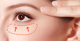 手術(shù)切除眼袋會(huì)留疤嗎