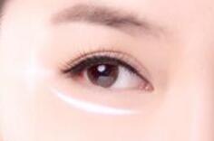 手術(shù)切除眼袋會有風(fēng)險嗎