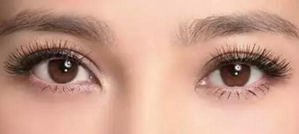 雙眼皮手術(shù)失敗了能修復(fù)多少次