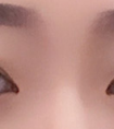 雙眼皮手術(shù)失敗了修復價格貴嗎