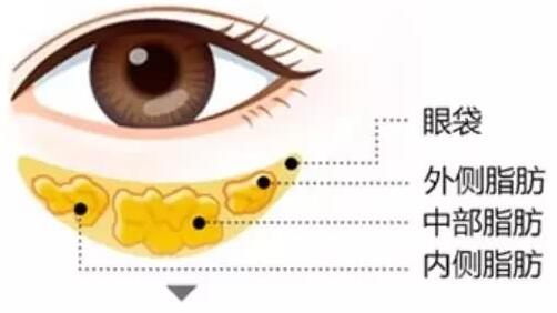 手術(shù)切除眼袋要注意哪些事項