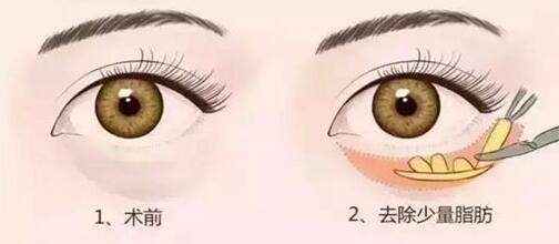 手術(shù)切除眼袋要注意哪些事項