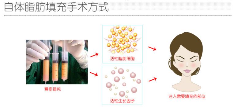 自體脂肪豐蘋果肌的 高嗎