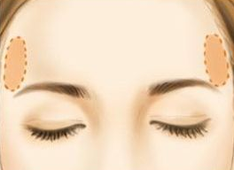 自體脂肪豐太陽穴需要多久恢復