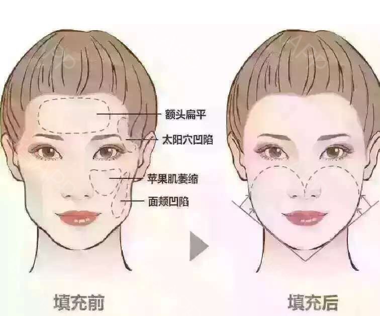 面部脂肪填充后臉腫了該怎么辦