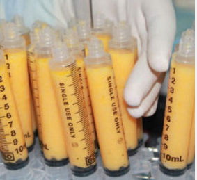 全臉脂肪填充多久恢復自然