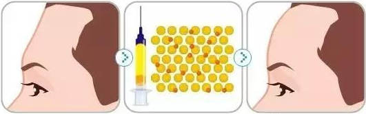 脂肪填充面部能維持多久