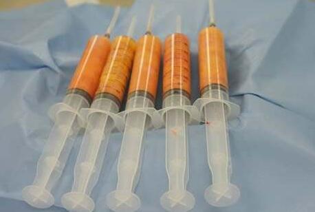 自體脂肪填充面部要多少錢