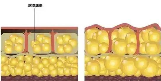 自體脂肪填充面部要多少錢