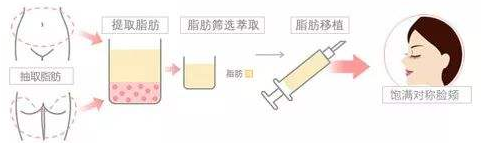 自體脂肪填充面部恢復期可以上班嗎
