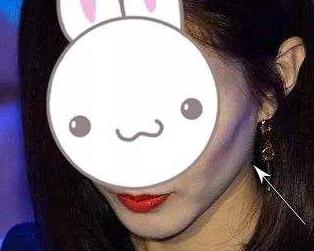 臉上的凹陷怎么辦