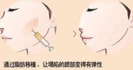 自體脂肪填充面部多久定型