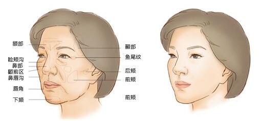 脂肪填充面部效果會(huì)受季節(jié)氣候影響嗎