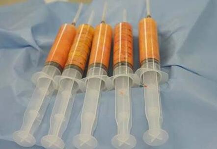 脂肪填充面部有硬塊怎么辦