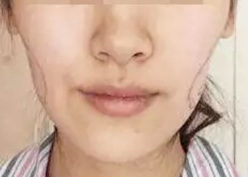 自體脂肪填充臉部會(huì)有后遺癥嗎