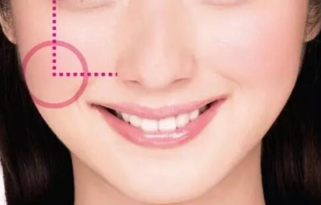 自體脂肪填充臉部多久恢復自然