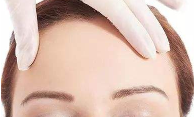 自體脂肪豐額頭好不好呢